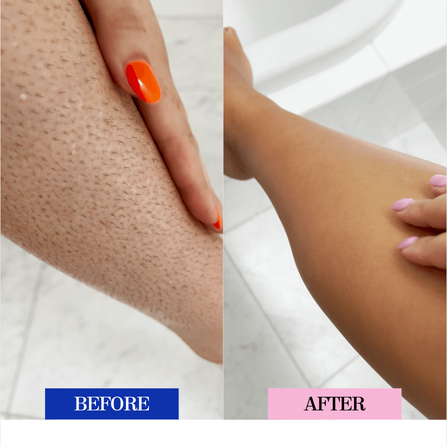Hair Removal Vancouver